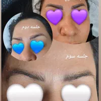 لیزر تتو و مو،ژل،بوتاکس،کربن تراپی،هایفو تراپی