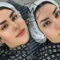 میکروبلیدینگ فیبروز شیدینگ خط چشم تخفیف