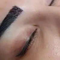 / کاشت مو و ابرو /بلفارو/ /عمل بینی ژل وبوتاکس