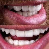 دندان پزشکی عصب کشی / لمینیت فقط ۱۰ م/ ترمیم/ روکش