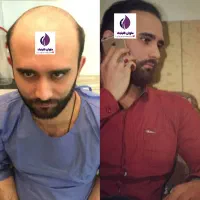 تخفیف پاییز تا یلدا کاشت مو و ابرو و مژه|خدمات آرایشگری و زیبایی|زاهدان, |دیوار