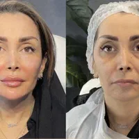 اصلاح لاغری صورت.جوانسازی روش یانگ فیس توسط پزشک