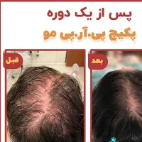 انجام خدمات لیزرو حذف موبدن باتخفیف۳۹۰،پی آرپی|خدمات آرایشگری و زیبایی|مشهد, گلبرگ|دیوار