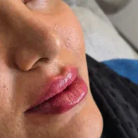 ژل و فیلر بوتاکس لیفت با نخ پی ارپی مقدم