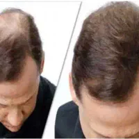 قطعی ریزش مو و رویش مجدد|آرایشی، بهداشتی، درمانی|اهواز, طالقانی|دیوار