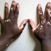 درمان اگزما و پیسی به صورت ریشه ای