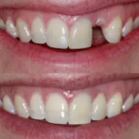 ایمپلنت،اوردنچر جایگزین دندان از دست رفته|خدمات آرایشگری و زیبایی|پردیس, فاز ۲|دیوار