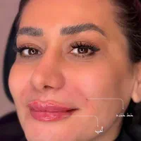 تزریق ژل لب عیدانه ۴۹۹