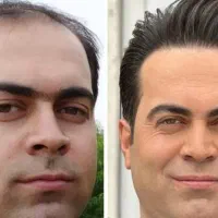 کاشت مو و ابرو تخصصی|خدمات آرایشگری و زیبایی|رشت, گلسار|دیوار