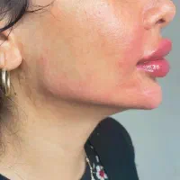 جشنواره فیلر بادی بدن باسن ممنوعه دست پا سی سی۱۸۰|خدمات آرایشگری و زیبایی|شیراز, شریفآباد|دیوار