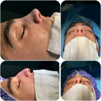 جراحی زیبایی بینی و ترمیمی|خدمات آرایشگری و زیبایی|قائمشهر, |دیوار