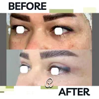 جشنواره بلفاروپلاستی جراحی پلک با بخیه لیزری|خدمات آرایشگری و زیبایی|تهران, شهرک غرب|دیوار