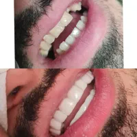 دندانپزشکی،کامپوزیت فکی7200،روکش ،لمینت،عصب کشیی