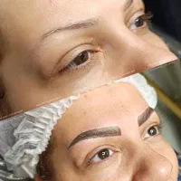 نانوبروزvipو ریموو و تتو بدن/ نمونه‌کار واقعی