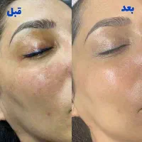 با فیشال تخصصی کلینیک لک و جوش خود را از بین ببر|خدمات آرایشگری و زیبایی|بندرعباس, |دیوار