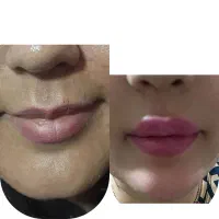 تزریق ژل و فیلر