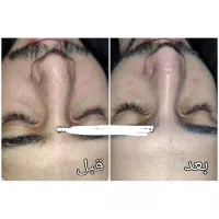 مدل فیشیال وی ای پی و درمان جوش|خدمات آرایشگری و زیبایی|تهران, مجیدیه|دیوار