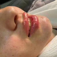 ژل و بوتاکس|خدمات آرایشگری و زیبایی|مشهد, ایثار|دیوار