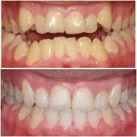 اورتودنسی دندان/۱۰م تخفیف/اقساط بدون سود|خدمات آرایشگری و زیبایی|فسا, |دیوار