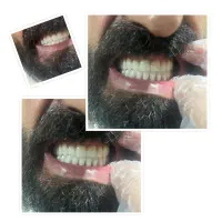 دندانسازی دندان مصنوعی فلکسی ژله ای