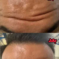 بوتاکس طبیعی