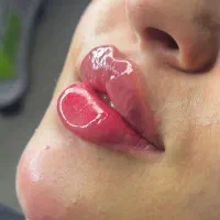 تزریق ژل و بوتاکس