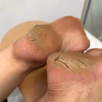 برطرف کردن ترک های کف پا و تیرگی قوزک دست و پا