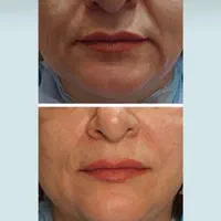 ژل فیلر بوتاکس جوانسازتوسط پزشک زیبایی در کلینیک|خدمات آرایشگری و زیبایی|مشهد, کوثر|دیوار