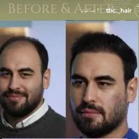 کاشت مو پر تراکم و طبیعی /اقساط ۶ ماهه