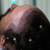 کاشت مو به روش شیرازی