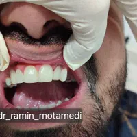 ایمپلنت/کامپوزیت/دندانپزشکی/اقساط