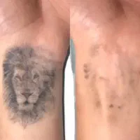 حذف تتو/رفع کک و مک/کربن تراپی/روشنسازی نواحی تیره|خدمات آرایشگری و زیبایی|مسجد سلیمان, |دیوار