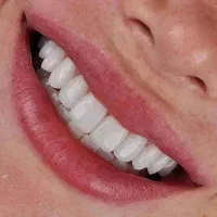 کامپوزیت دندان کامپوزیت زیبایی ونیر|خدمات آرایشگری و زیبایی|قم, چهار امامزاده|دیوار