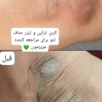 لیزر لک و لیزر کربن تراپی لاغری با کویتیشن و اراف|خدمات آرایشگری و زیبایی|فولادشهر, B4|دیوار