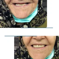 دندان مصنوعی اقساط و بیمه|خدمات آرایشگری و زیبایی|کرمان, |دیوار