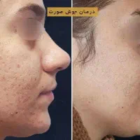 لیزر لک و لیزر کربن تراپی لاغری با کویتیشن و اراف|خدمات آرایشگری و زیبایی|فولادشهر, B4|دیوار