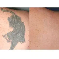 پاک کردن تتو با کیوسوییچ|خدمات آرایشگری و زیبایی|ارومیه, |دیوار