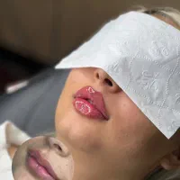ژل لب و بوتاکس و کانتورینگ صورت