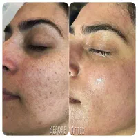 رفع لک ها و روشن سازی پوست|خدمات آرایشگری و زیبایی|اصفهان, مفتح|دیوار