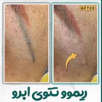 پاک کردن تتو ابرو و ریموو خالکوبی بدن توسط پزشک|خدمات آرایشگری و زیبایی|رشت, گلسار|دیوار