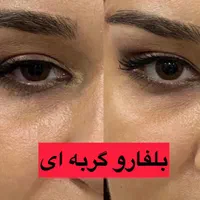 بلفاروپلاستی-سانترال لب-بوکال فت-ساکشن غبغب|خدمات آرایشگری و زیبایی|تهران, پاسداران|دیوار
