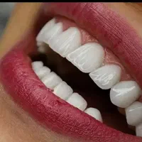 کامپوزیت ، لمینیت ، ایمپلنت بدون پیش پرداخت