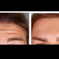 جشنواره تزریق ژل بوتاکس فیلر پی آرپی مطب زیبایی|خدمات آرایشگری و زیبایی|تبریز, |دیوار