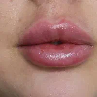 تزریق ژل و بوتاکس