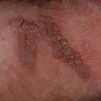 درمان محرمانه و قطعی زگیل و تبخال تناسلی(HPVوHSV)