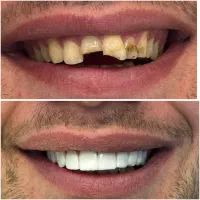 تخفیف پاییزی کلینیک دندان پزشکی دی