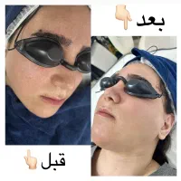 پاکسازی پوست به صورت حرفه ای فقط ۴۰۰ت|خدمات آرایشگری و زیبایی|قائمشهر, |دیوار