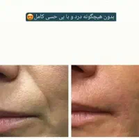 ژل بوتاکس آنزیم مزوتراپی پرسینگ فشیال فیلر|خدمات آرایشگری و زیبایی|مشهد, صیاد شیرازی|دیوار