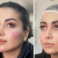 تزریق ژل لب فیلر زاویه سازی صورت فک گونه بوتاکس|خدمات آرایشگری و زیبایی|فردیس, خیام شرقی|دیوار