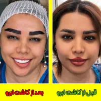 جشنواره نوروزی کاشت تخصصی ابرو + شرایط اقساط